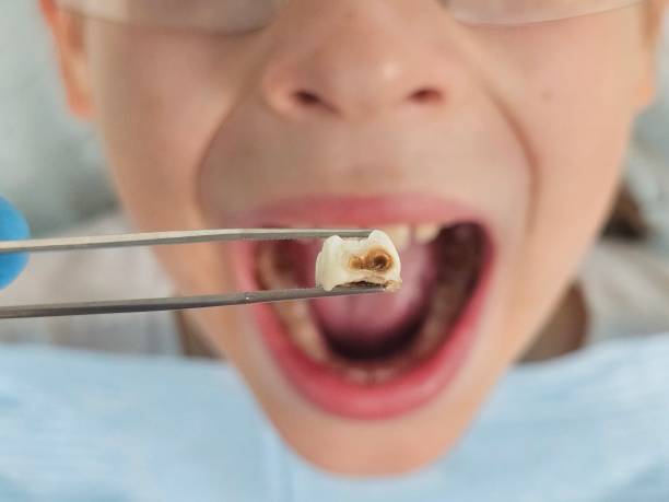Best Dentist for Tooth Abscess  in Avimor, ID